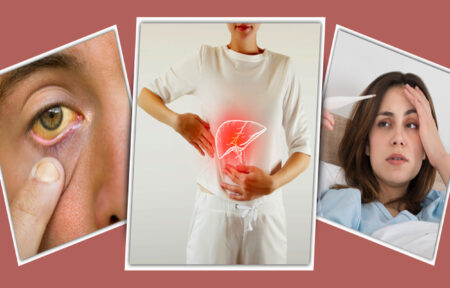 হেপাটাইটিস এ