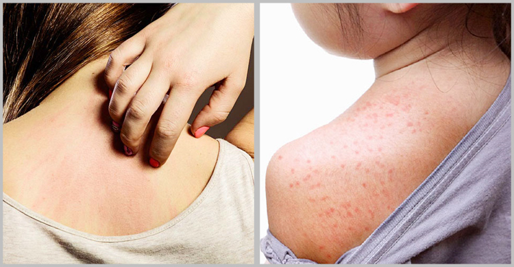 ঘাম ও ঘামাচি